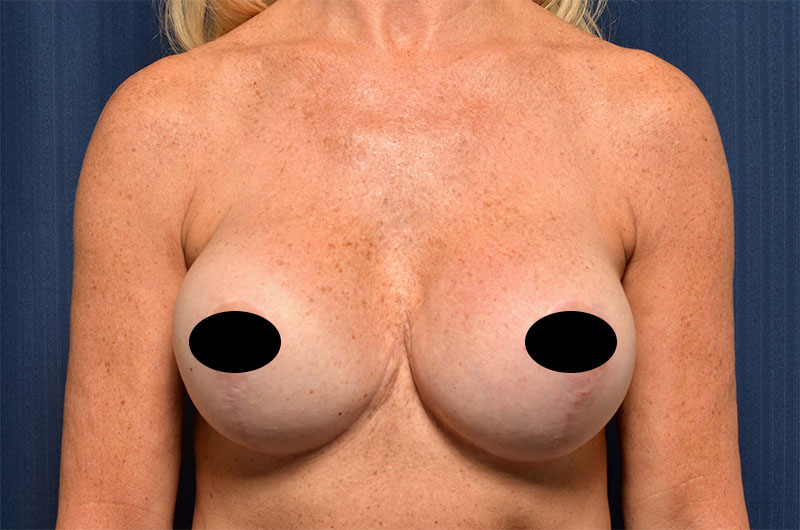 Breast Implant Revision