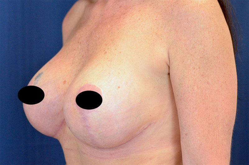 Breast Implant Revision