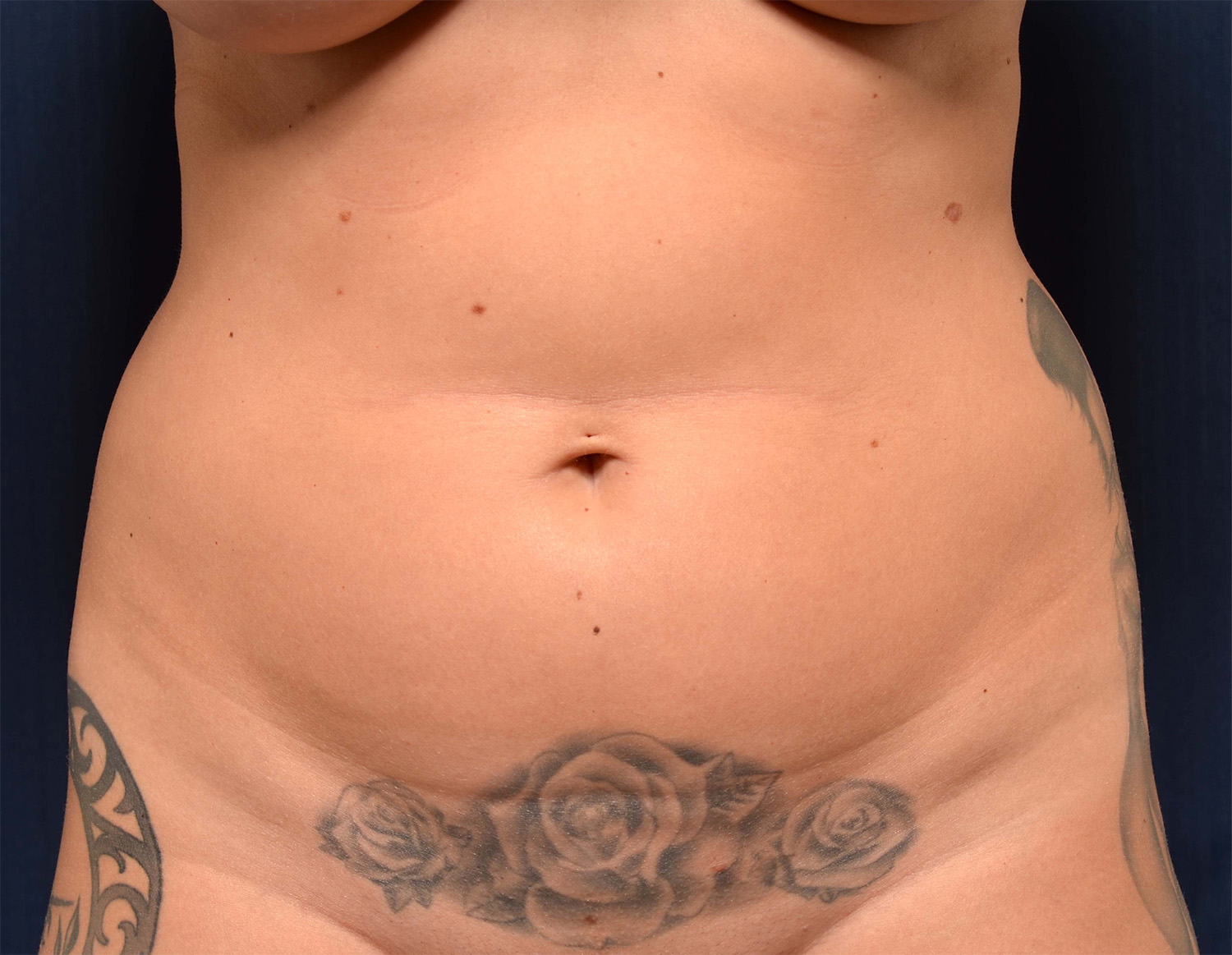 Liposuction