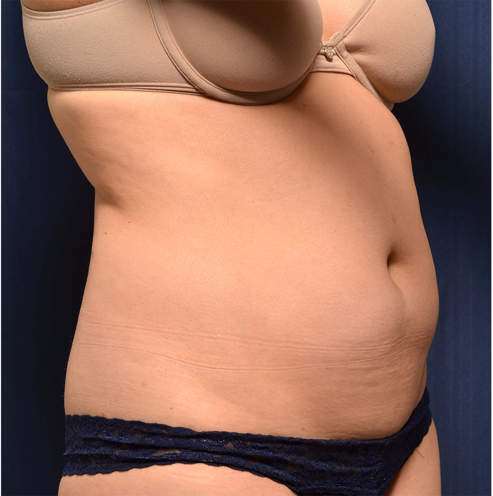 Liposuction