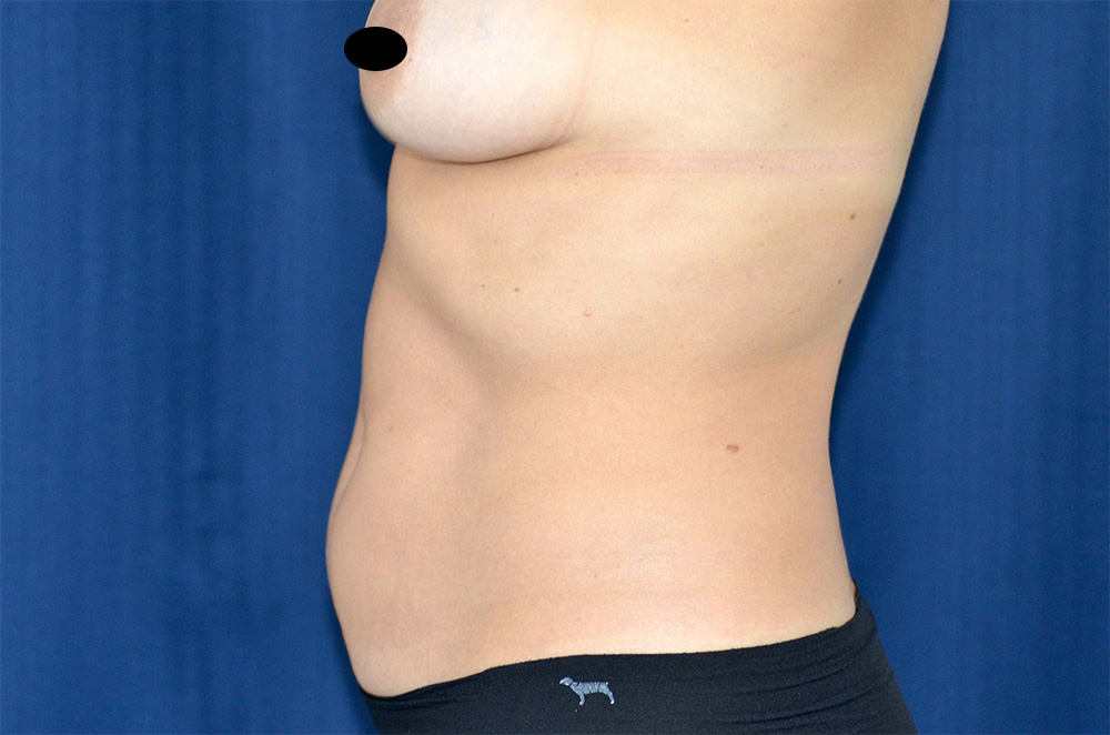 Liposuction