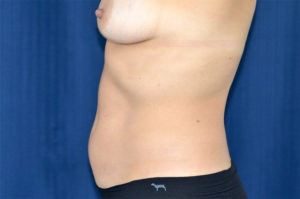 Le Spa Plastic Surgery Before and After Photos