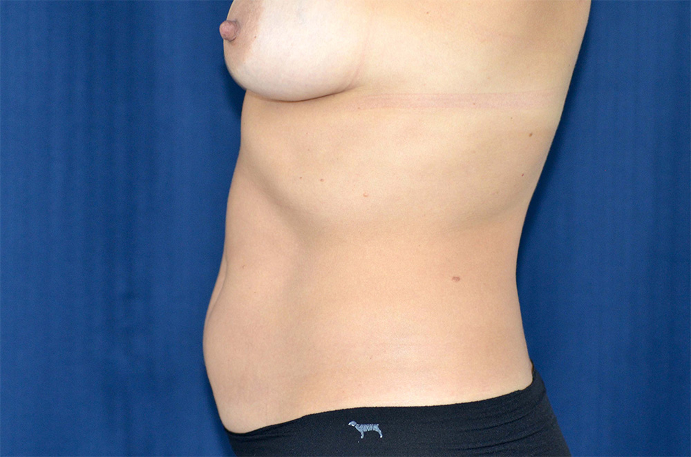 Liposuction