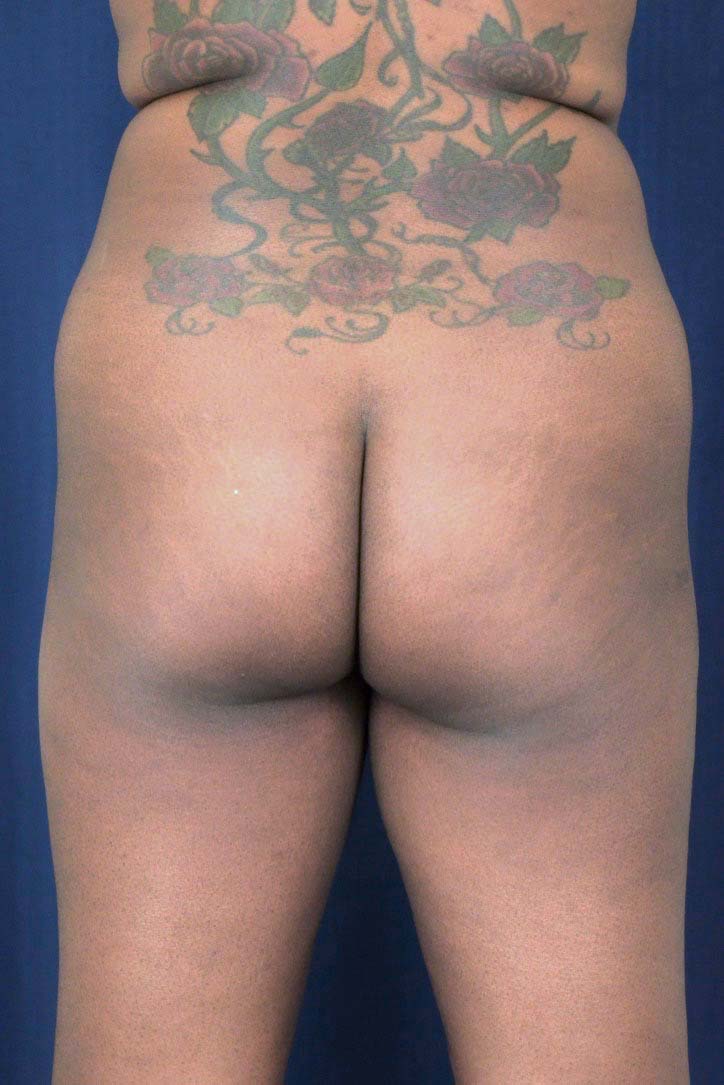 Brazilian Butt Lift Before & After