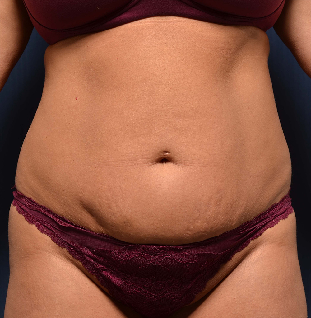 Tummy Tuck