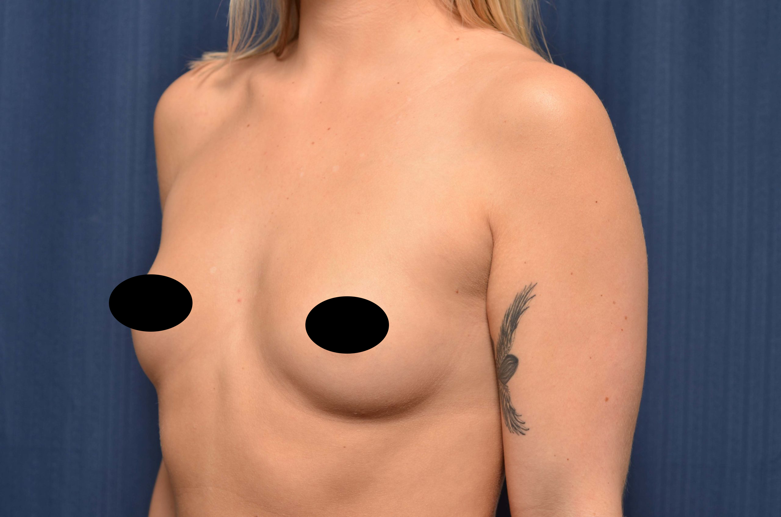 Breast Augmentation Before and After