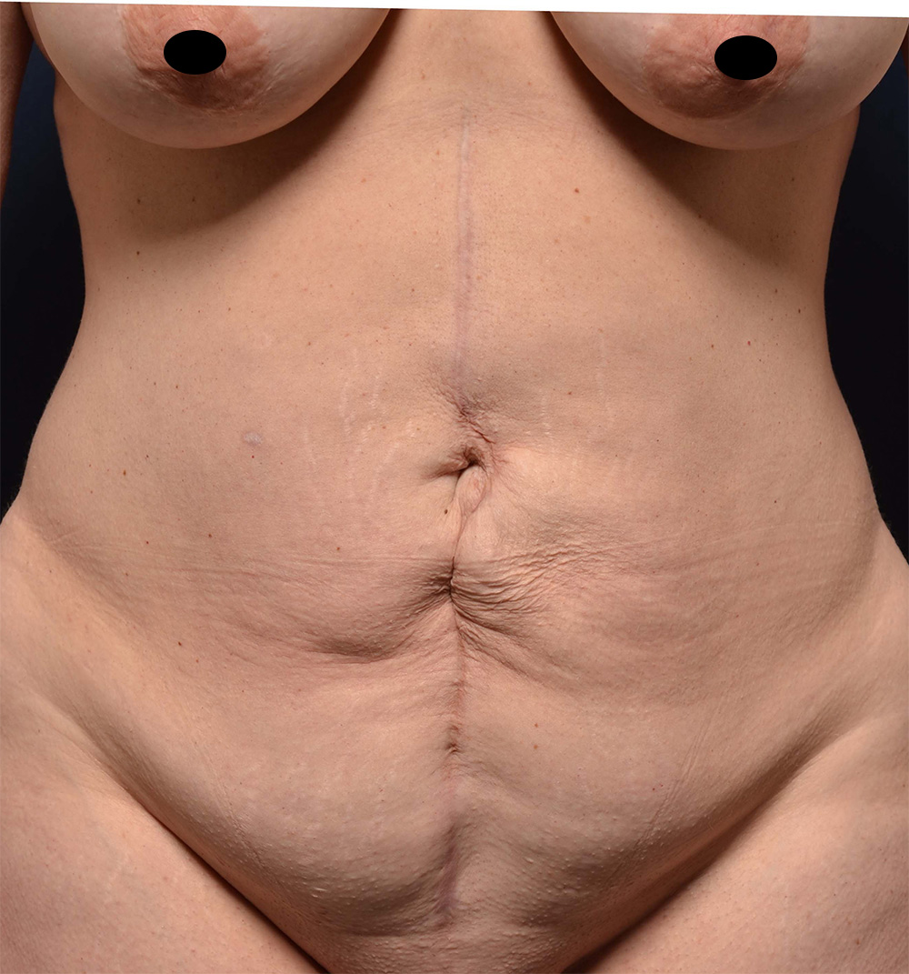 Tummy Tuck