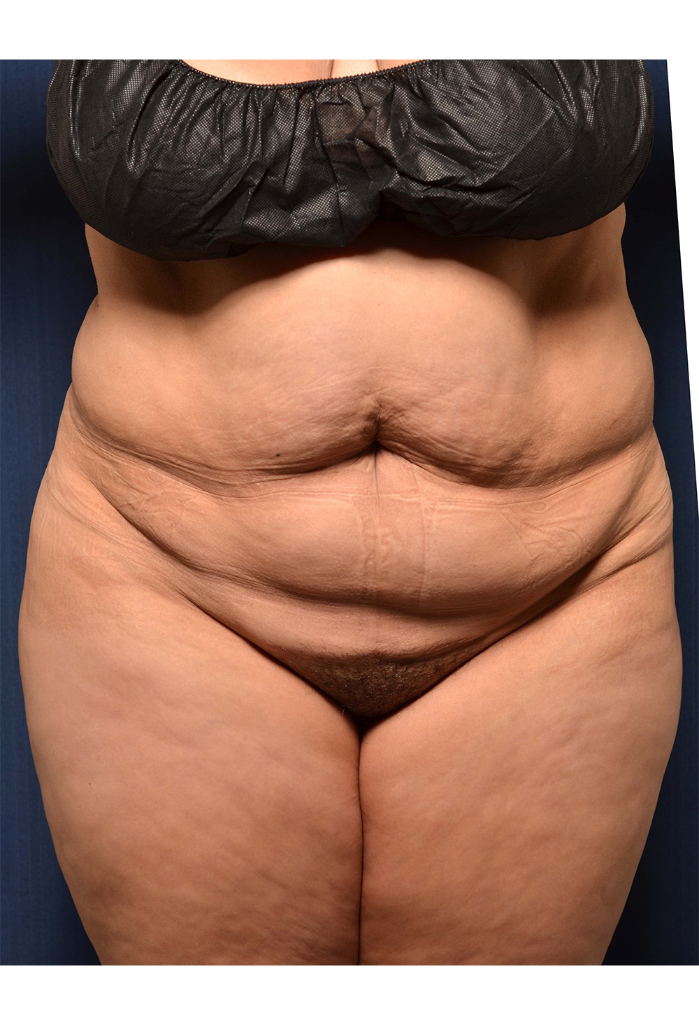 Tummy Tuck