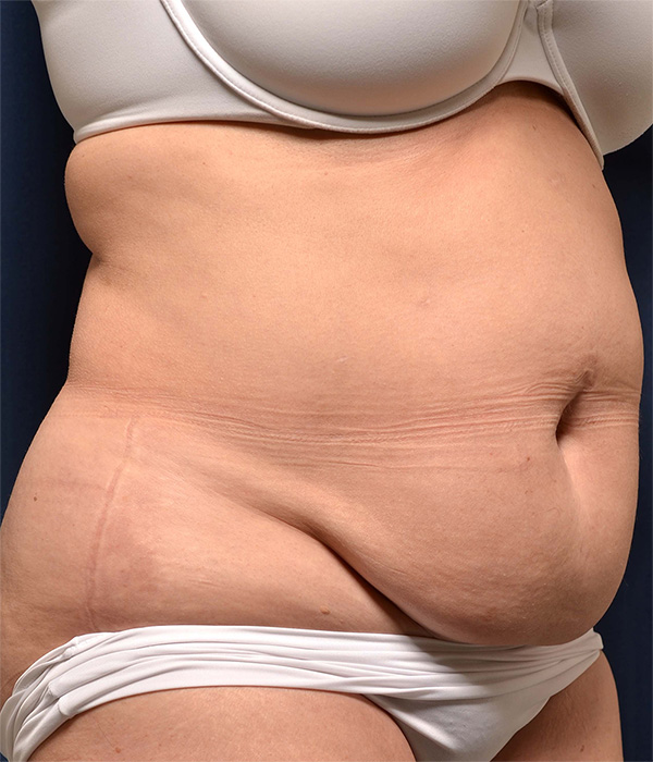 Tummy Tuck