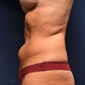 27 Woman After Tummy Tuck w Lipo 360