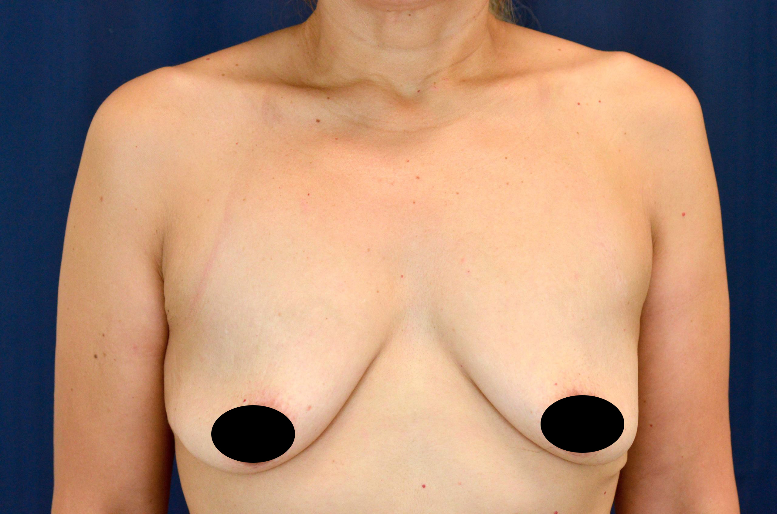 Breast Augmentation with Lift