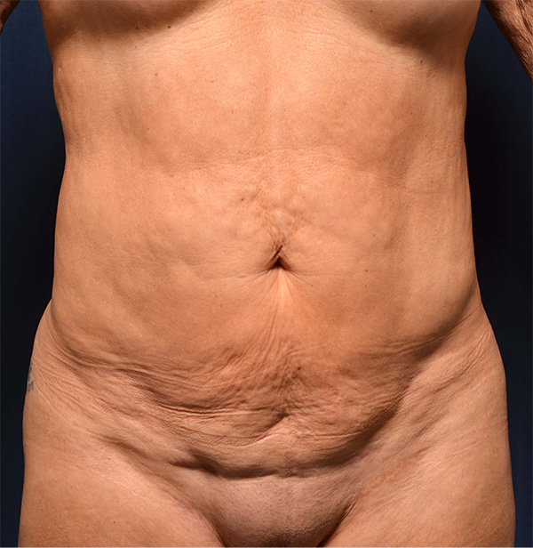 Tummy Tuck