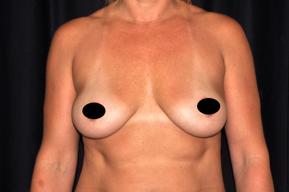 Breast Augmentation with Lift