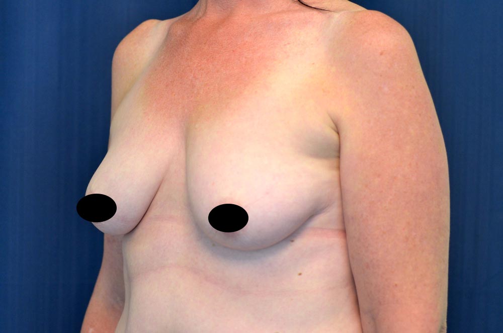 Breast Augmentation with Lift