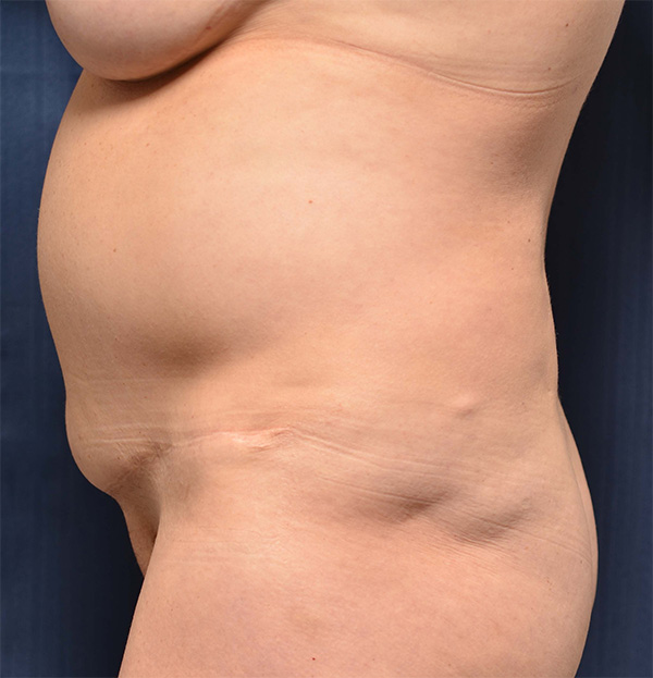 Tummy Tuck