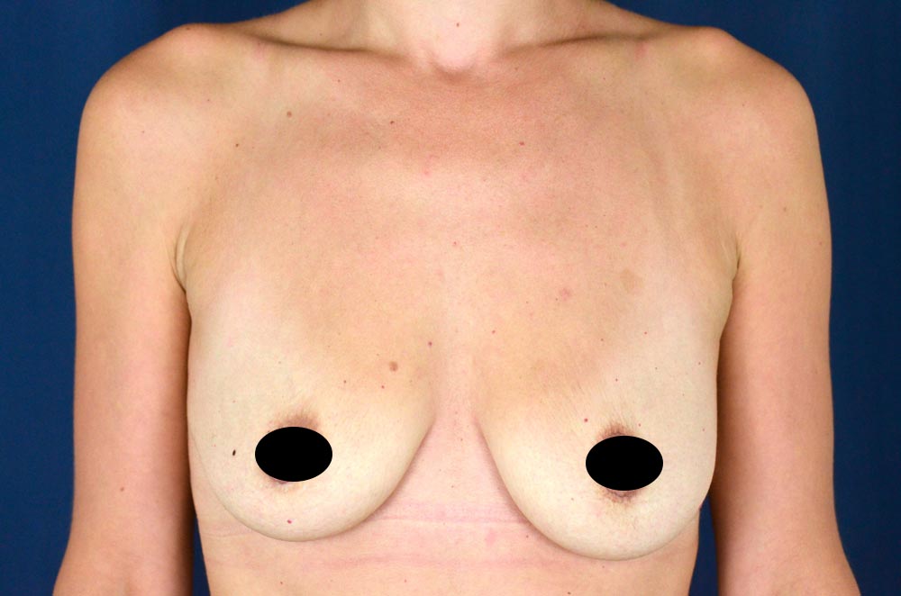 Breast Augmentation with Lift