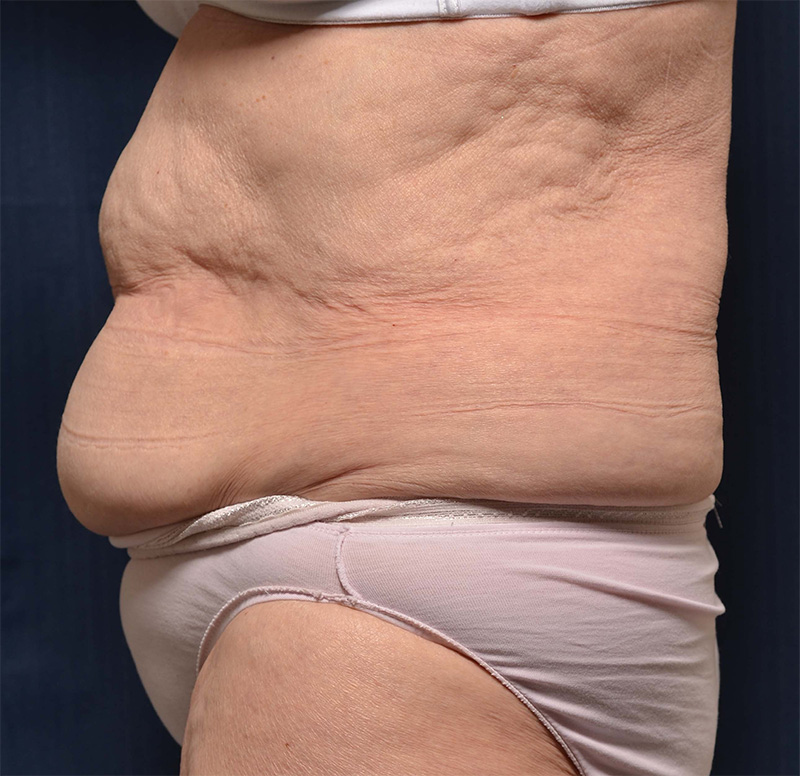 Tummy Tuck