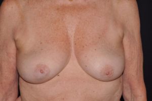 Le Spa Plastic Surgery Before and After Photos
