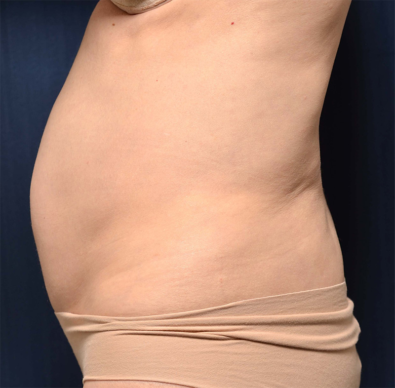 Tummy Tuck