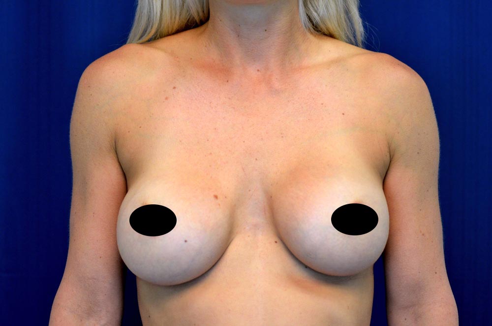 Breast Implant Revision