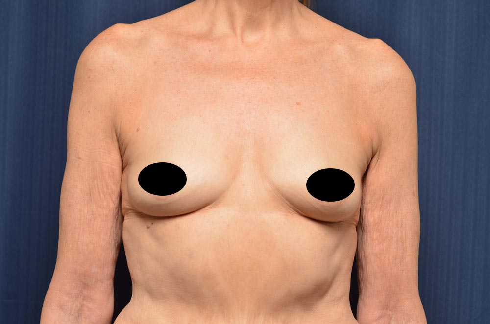 Breast Augmentation Before and After