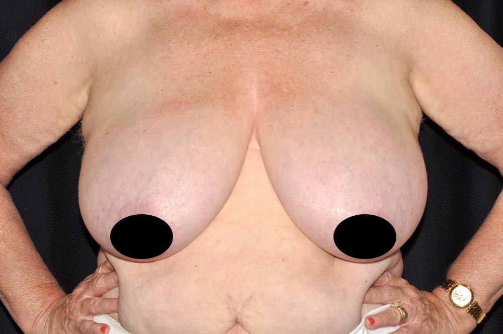 Breast Lift Reduction