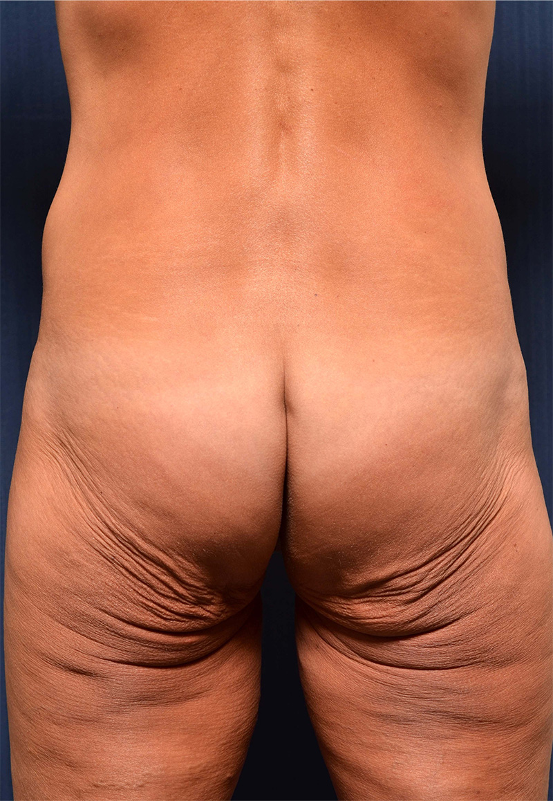 Body Lift / Upper Back Lift