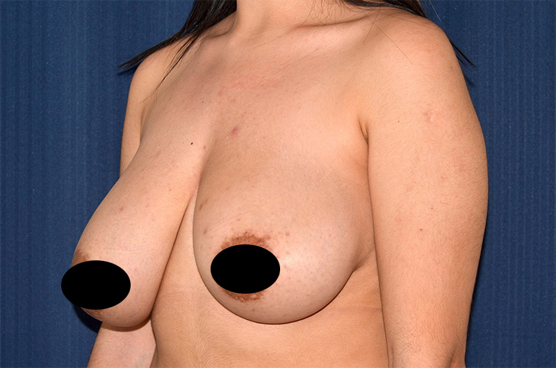 Breast Lift Reduction