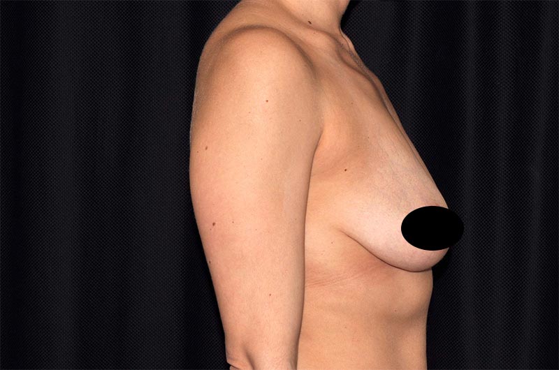 Breast Lift Reduction