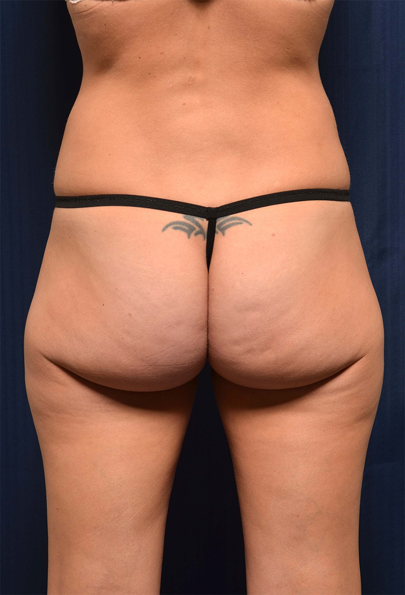 Brazilian Butt Lift Before & After