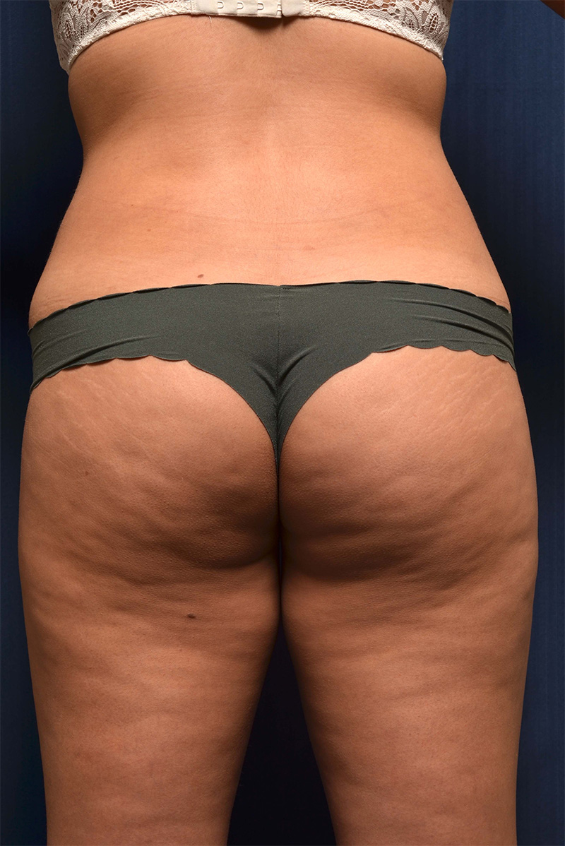 Brazilian Butt Lift Before & After