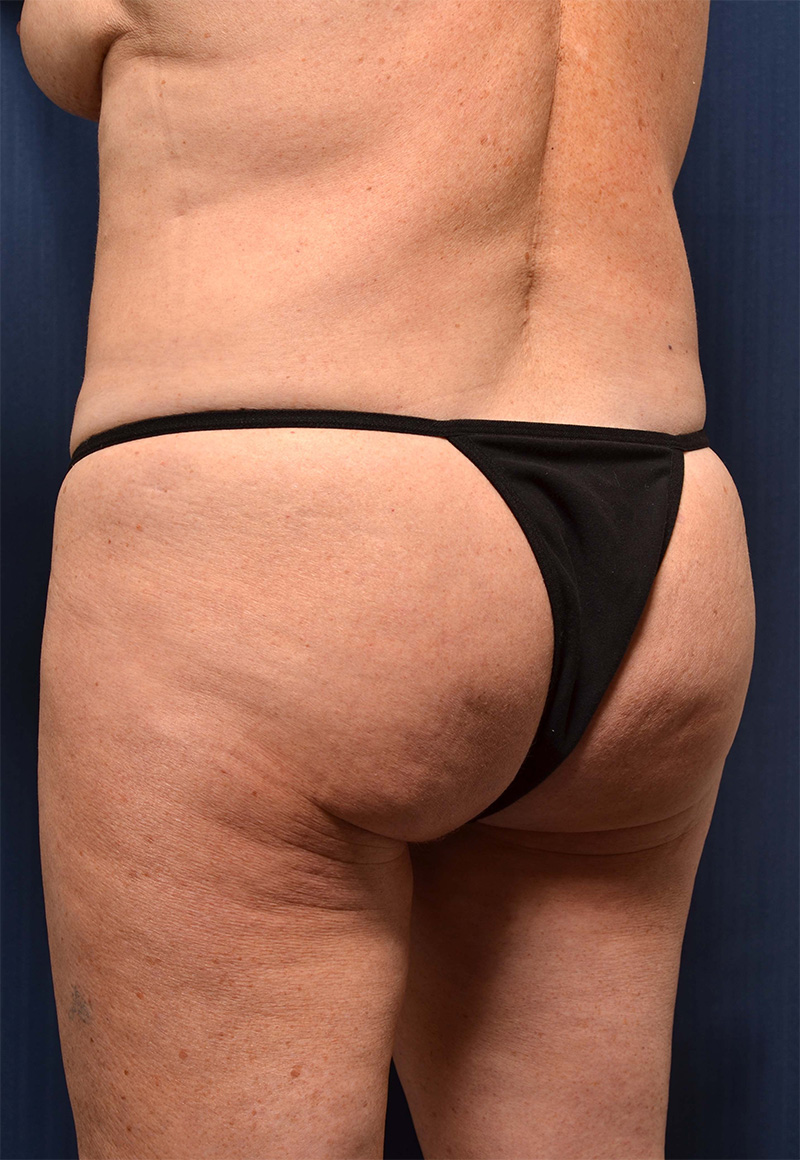 Brazilian Butt Lift Before & After