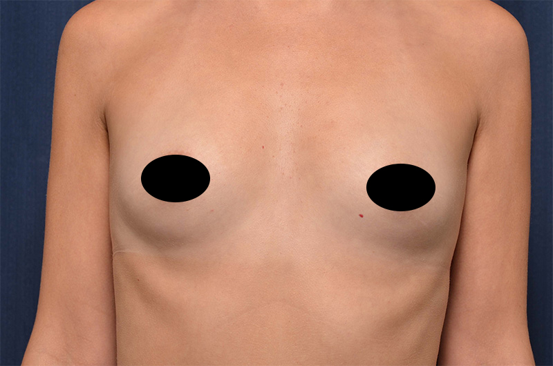 Breast Augmentation Before and After