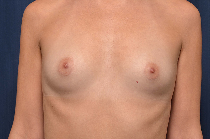 Breast Augmentation Before and After
