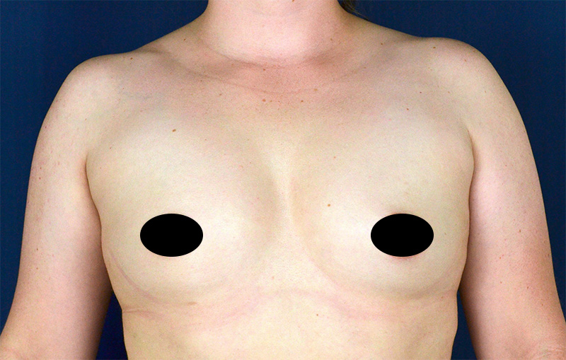 Breast Augmentation Before and After