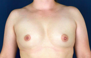 Le Spa Plastic Surgery Before and After Photos