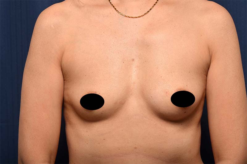 Breast Augmentation Before and After