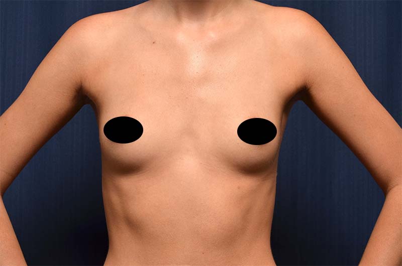 Breast Augmentation Before and After