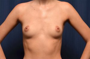 Le Spa Plastic Surgery Before and After Photos