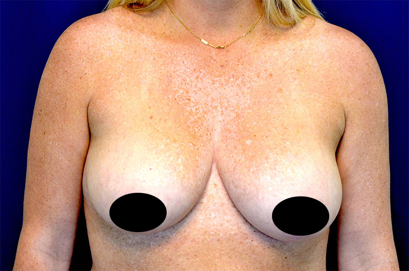 Breast Augmentation with Lift