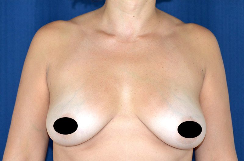 Breast Augmentation with Lift