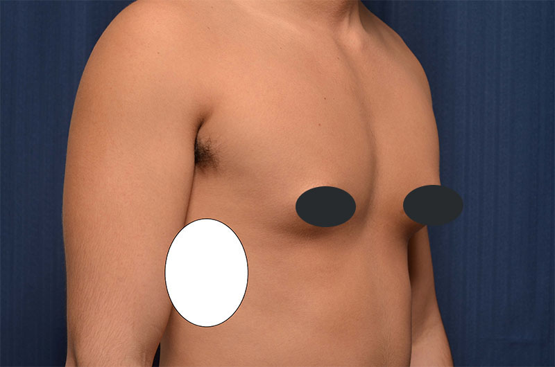 Gynecomastia