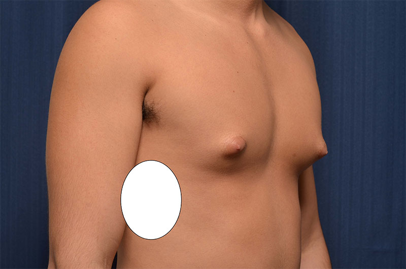 Gynecomastia