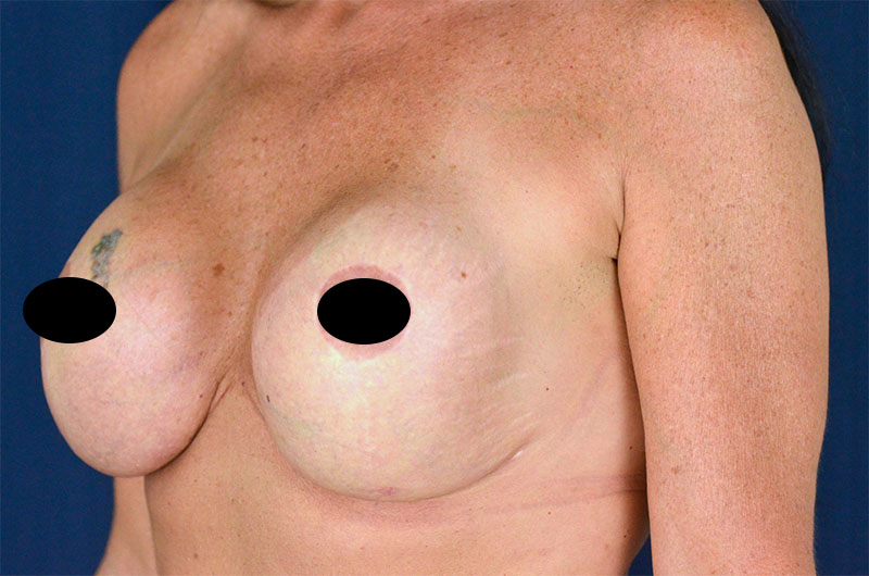 Breast Implant Revision