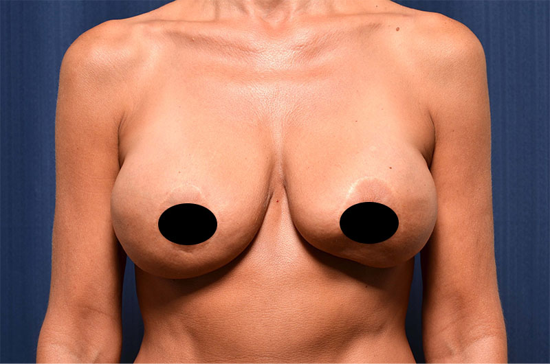 Breast Implant Revision