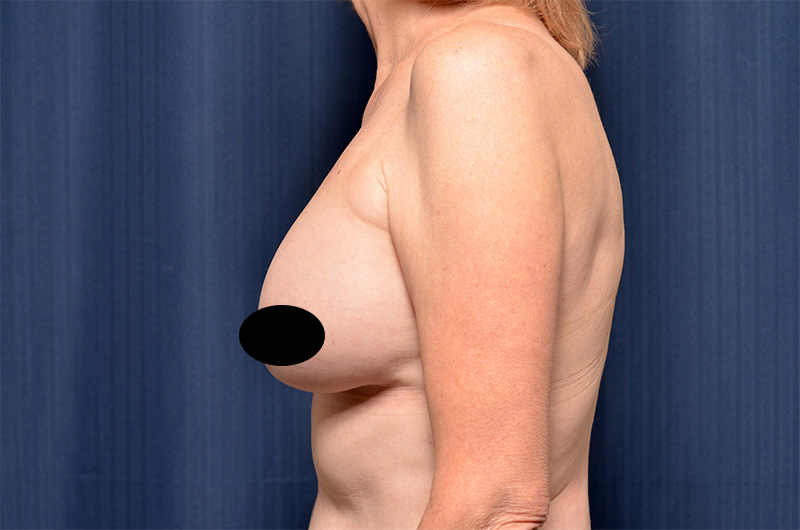 Breast Implant Revision