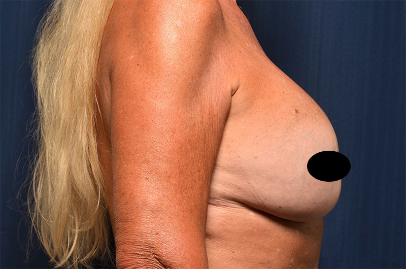 Breast Implant Revision