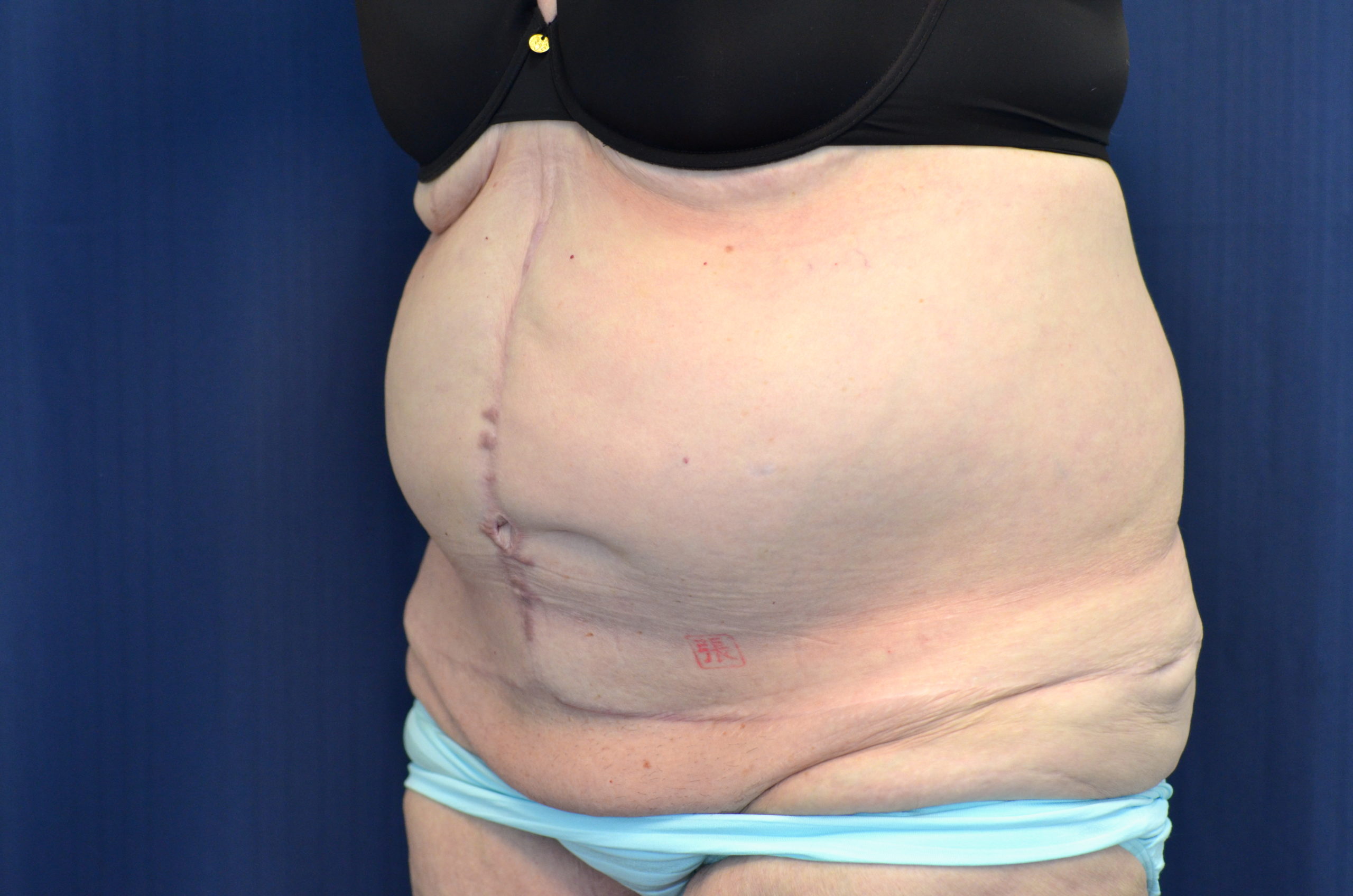 Tummy Tuck