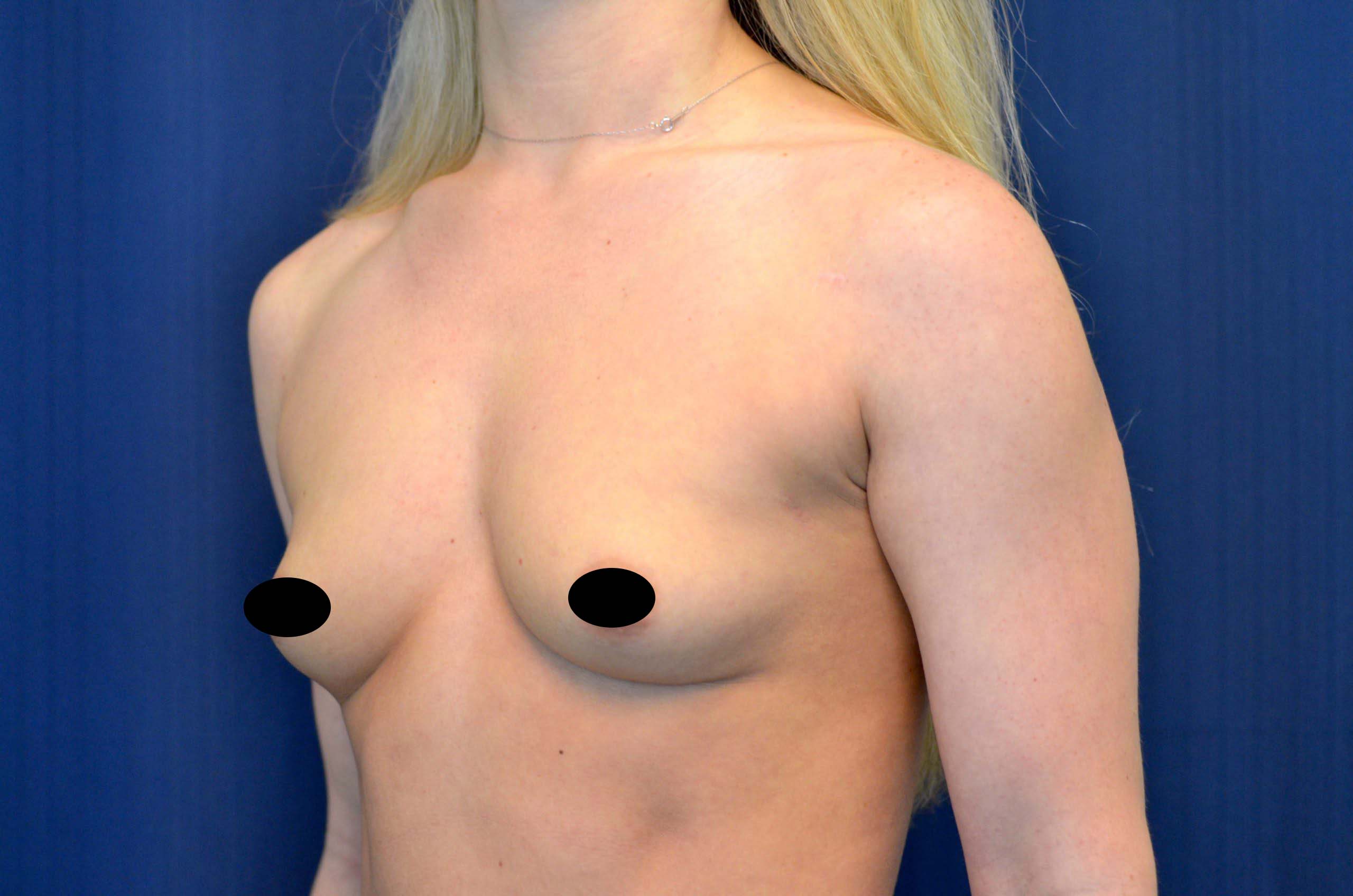 Breast Augmentation Before and After