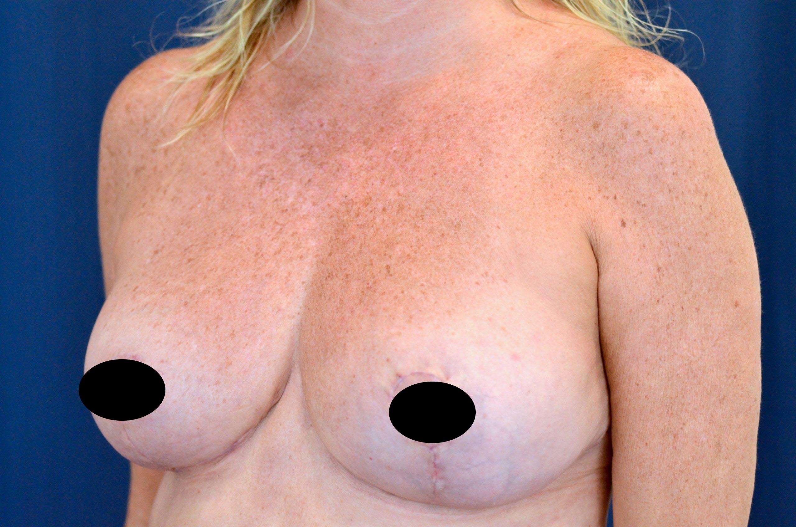 Breast Lift Reduction